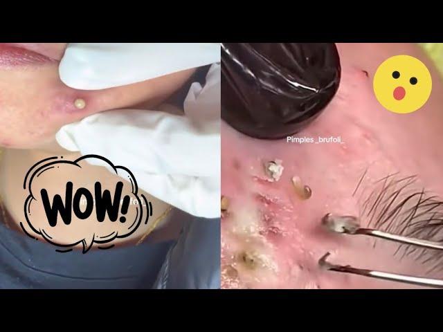 Unveiling the Secrets of Blackheads: Acne and Pimple Removal