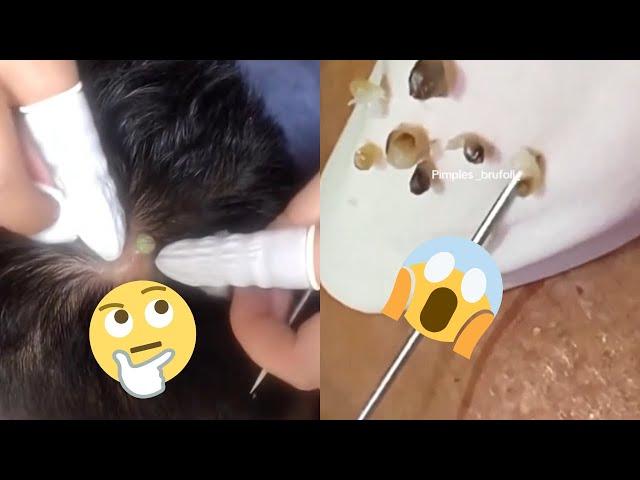 Ultimate Pimple Popping Compilation: Prepare to Be Amazed!