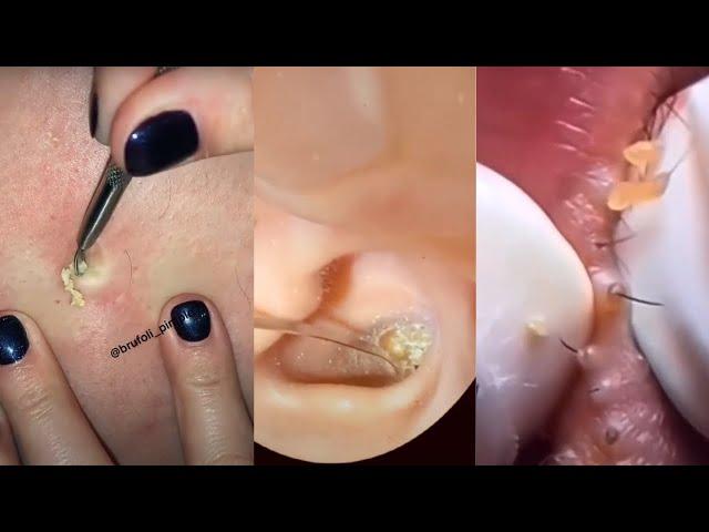 Ultimate Deep Blackhead Extraction: Satisfying Skin Care & Pimple Popping