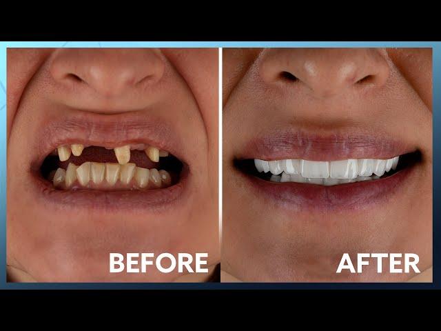 Unbelievable Smile Transformation: a New Yorker at Kristal Clinic