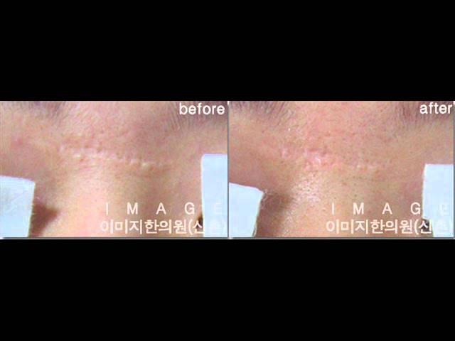 자향미한의원, 이미지한의원, 아전인수, 한방피부과전문의, 흉터침, 성형흉터, OT침, 교통사고 흉터, 흉터칼럼, 레이저부작용, 후유증, 색소침착, 착색, 화상, 피부, 진피재생