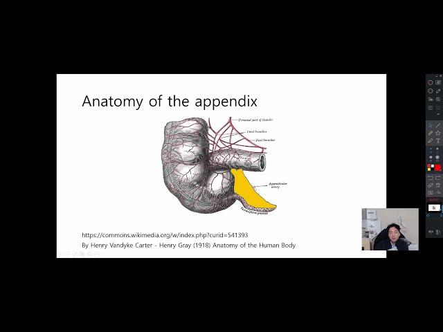 아뻬하는 법 (1/2) - 충수염 (맹장염, appendicitis) 이론 및 복강경 충수돌기절제술 (Laparoscopic appendectomy) 술기