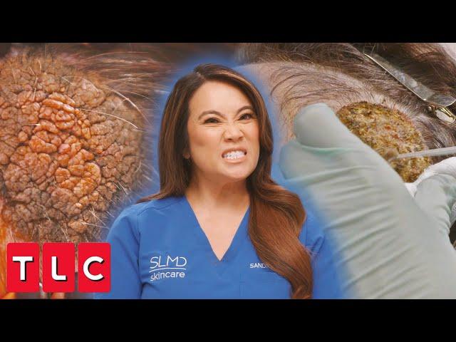 Dr. Lee Removes Spongy, Brainlike Bump on Patient's Head | Dr. Pimple Popper