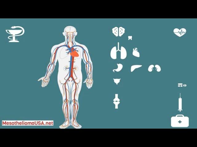 Mesothelioma UCLA - Comprehensive Mesothelioma Program