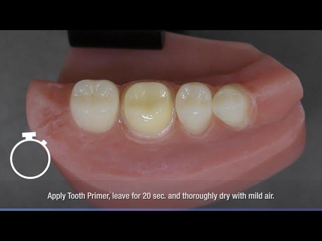 Panavia V5 work flow zirconia crown cementation