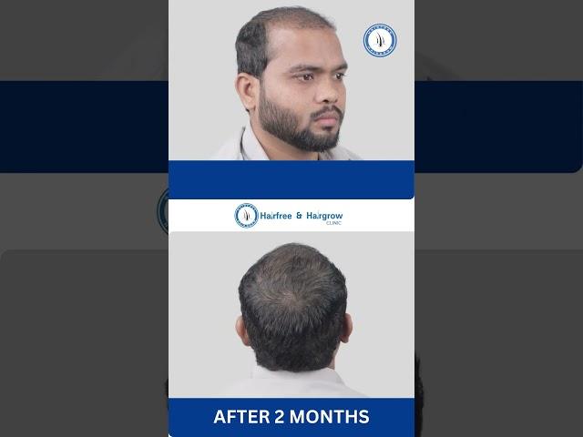 3800 Grafts Hair Transplant in Surat || Best Results & Cost of Hair Transplant in Surat Gujarat