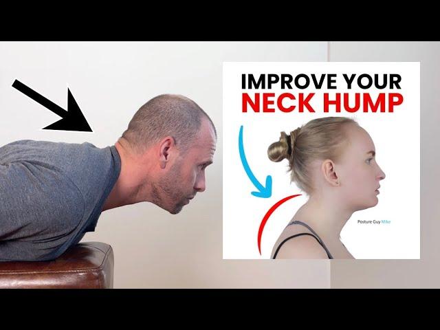 Fix Your Stubborn Neck Hump with These Simple At-Home Exercises!