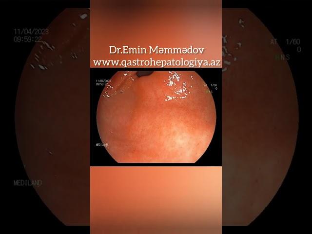 Mədə müayinəsi-Endoskopiya●○Dr.Emin Məmmədov #qastroenteroloq #hepatoloq #mədə