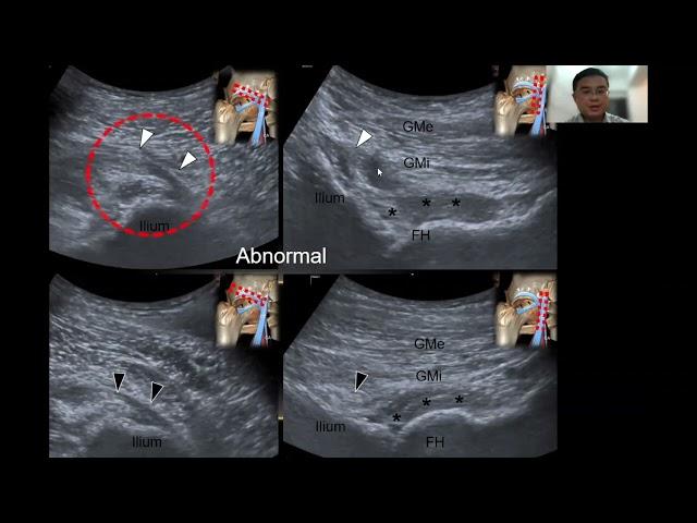 Dr. Kevin Chang talks about Ultrasound-guided Injection of the Hip Joint