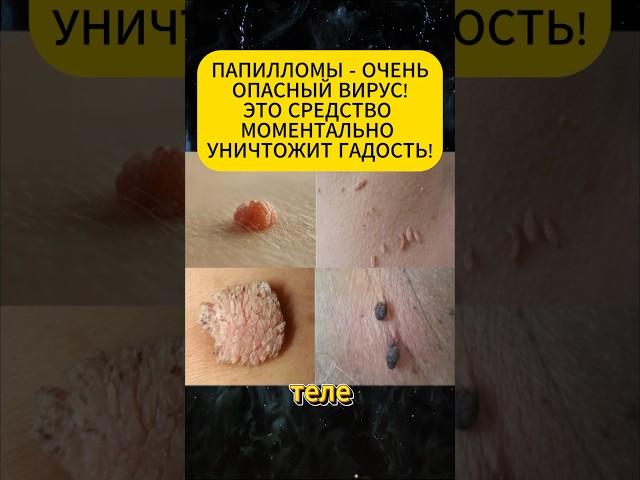 ЧУДО НАРОДНОЕ СРЕДСТВО УНИЧТОЖИТ ВСЕ ПАПИЛЛОМЫ И ВПЧ!