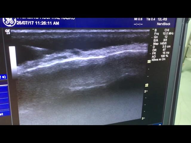 Greater Occipital Nerve Block