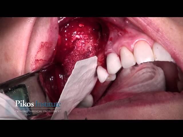 Abutment Fixation of Collagen Membrane Sinus Graft - Pikos Pearl