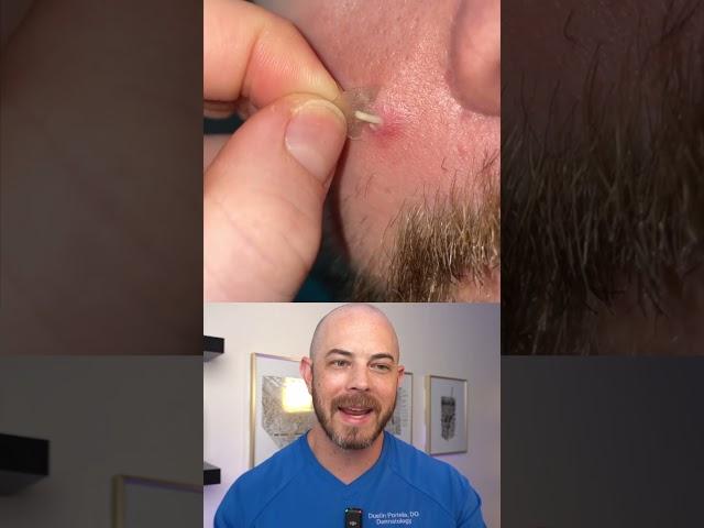 Doctor reacts to slimy pimple patch removal! #dermreacts #doctorreacts #pimplepop