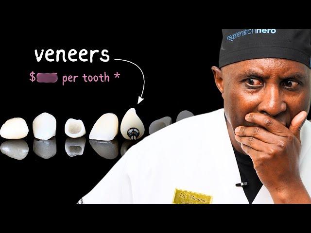 Why your fillings and veneers cost that much | Dental Bonding