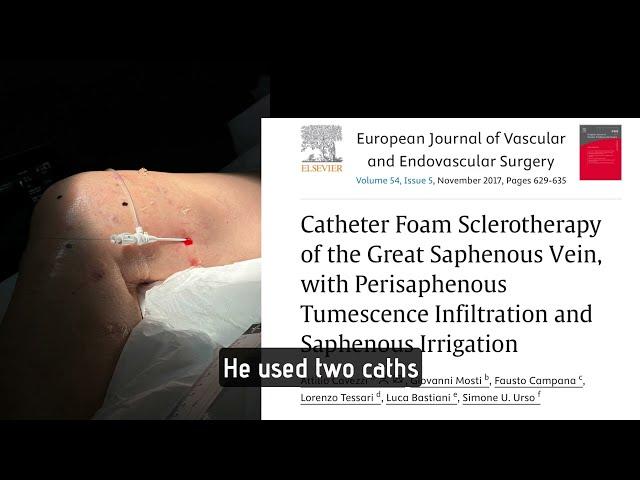 Catheter Delivered FoamSclerotherapy for Incompetent GSV