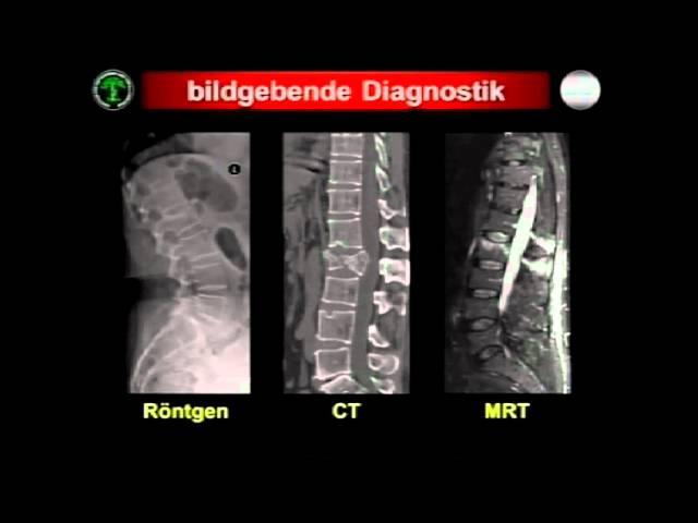 Rekonstruktion und Stabilisierung von Wirbelsäulenverletzungen