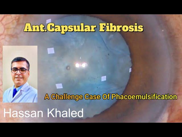 Phacoemulsification & Anterior Capsular Fibrosis