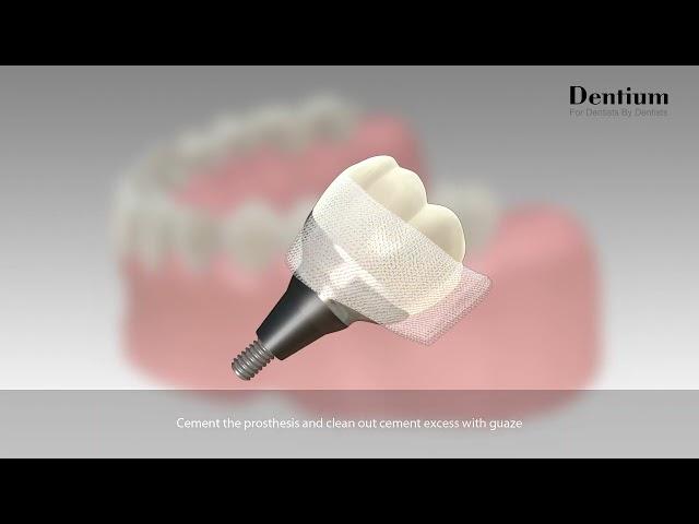 Dentium Customized Abutment