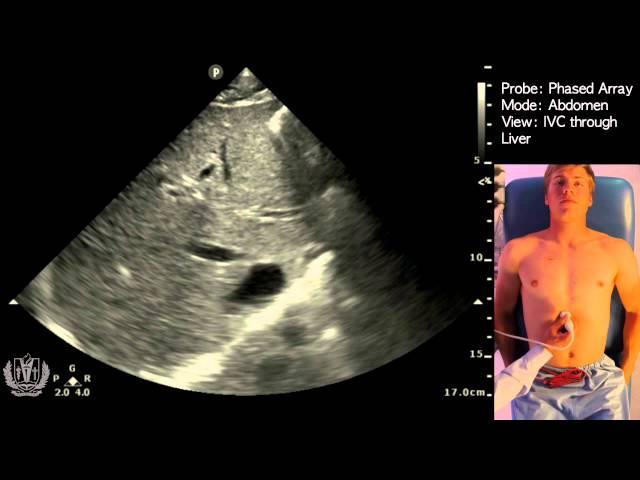 IVC Ultrasound STEP by STEP - Easiest Method