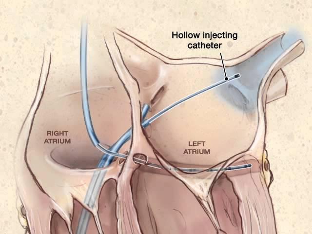 Pulmonary Vein Radiofrequency Catheter Ablation Therapy for Atrial Fibrillation