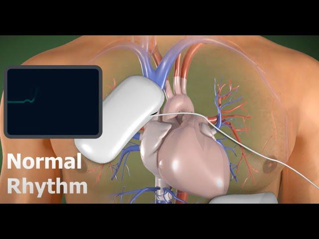 AED - 3D Medical Animation