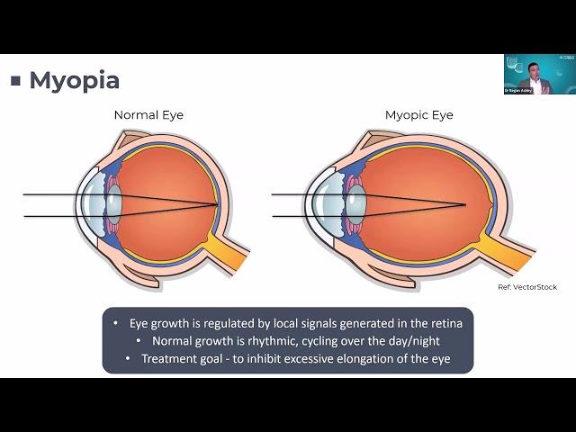 How does being outdoors prevent the development of Myopia? (11 June 2024)