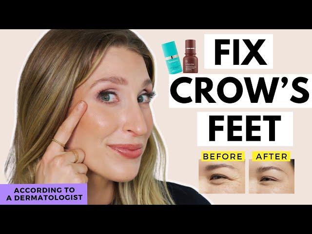 Treatments for Crow's Feet That WORK | Fix Eye Wrinkles | Dr. Sam Ellis