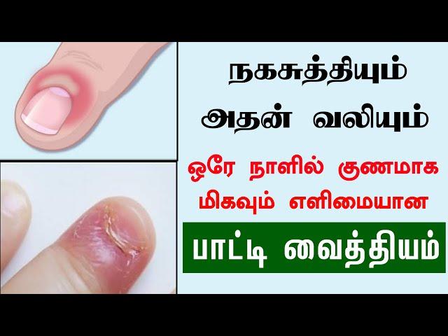 நகசுத்தி ஒரே நாளில் குணமாக எளிமையான வைத்தியம் | How to Cure Nail Fungus Naturally | Naga suthi