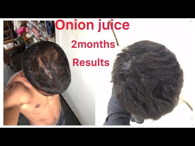 Best hair growth result in 2 months using ONION JUICE #hairloss#hairgrowth #hair #trending #hairfall