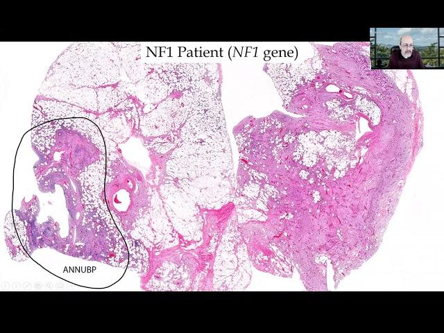 AANP Teaching Rounds - July 25 - Hereditary Tumor Syndromes