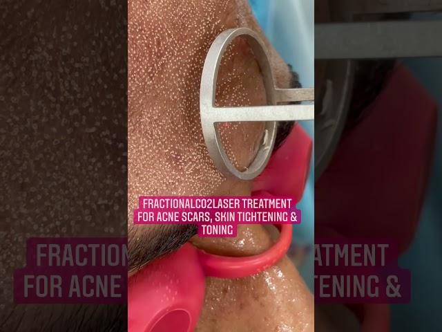 FractionalCO2laser Treatment for Acne Scars| Dermatologist|Skin tightening | Chandigarh #shorts