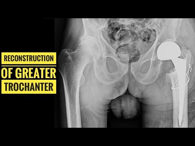 Greater Trochanter Reconstruction with Cercelage wire in Hip Hemiarthroplasty, THR and Revision THR