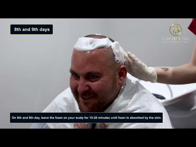 Hair Washing After Hair Transplantation 2023 - Now Hair Time