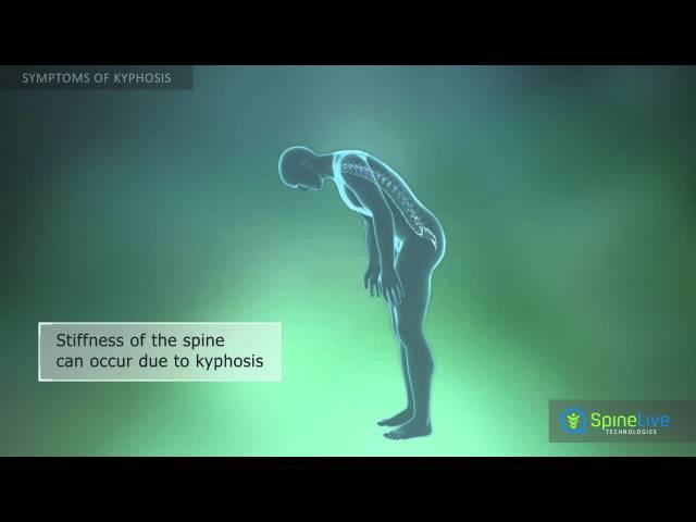 Kyphosis Symptoms