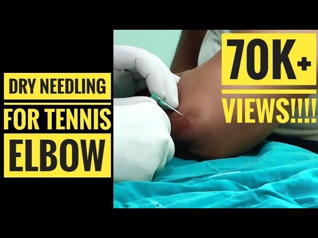 Dry Needling for Tennis Elbow