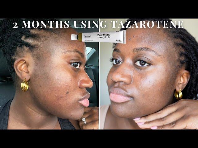 I USED TAZAROTENE FOR 2 MONTHS | TAZAROTENE VS TRETENOIN