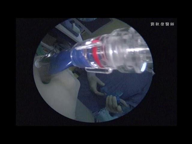 耳咽管阻塞的簡易內視鏡氣球擴張術 E-tube Balloon Tuboplasty