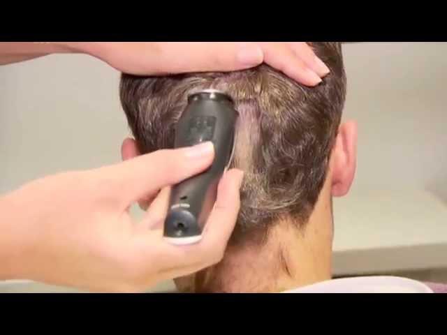 Erik Vermeulen Haartransplantation bei KÖ HAIR