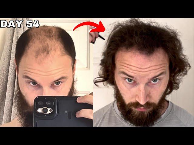 BALDING HAIR GROWTH For 1.5 Years - Reviewed