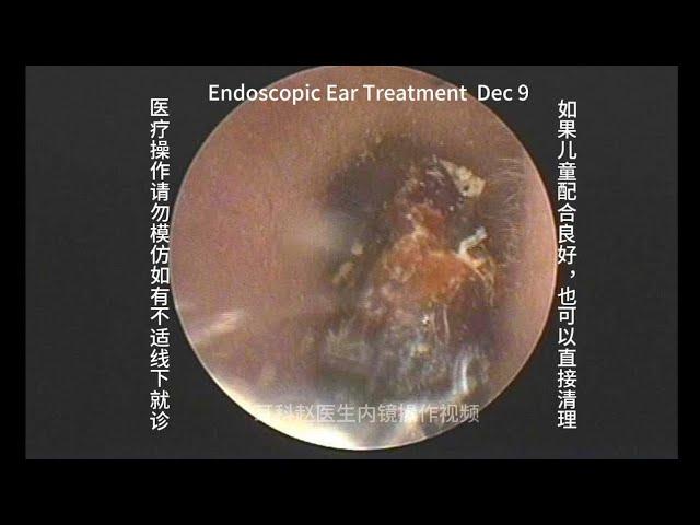 Childhood earwax embolism, soaked in ear drops and softened before cleaning 20241209