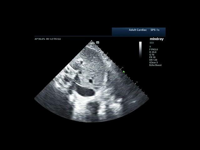 How to... Measure IVC Diameter