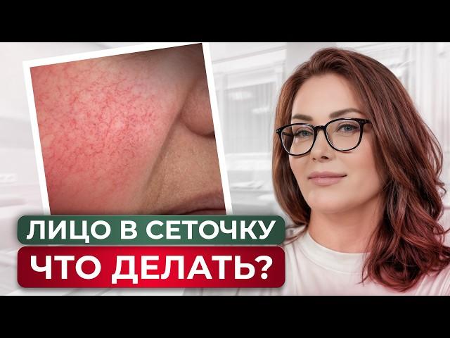 Как избавиться от сосудов на лице? ЛУЧШЕЕ ЛЕЧЕНИЕ КУПЕРОЗА И РОЗАЦЕА!