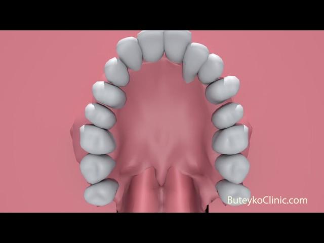 How does mouth breathing cause crooked teeth? by Patrick McKeown