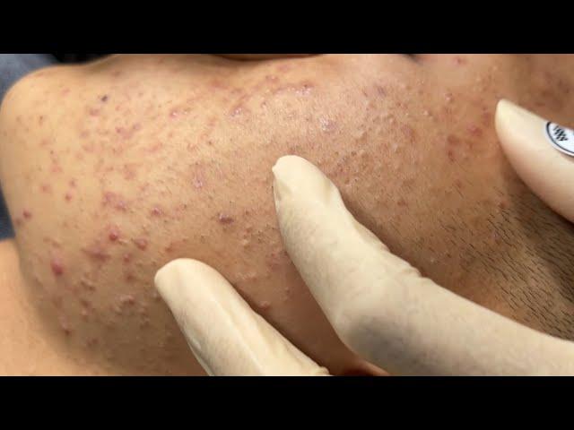 Blackheads & Whiteheads Removal New 2024 | Acne Treatment With Bo Nguyễn Spa #007