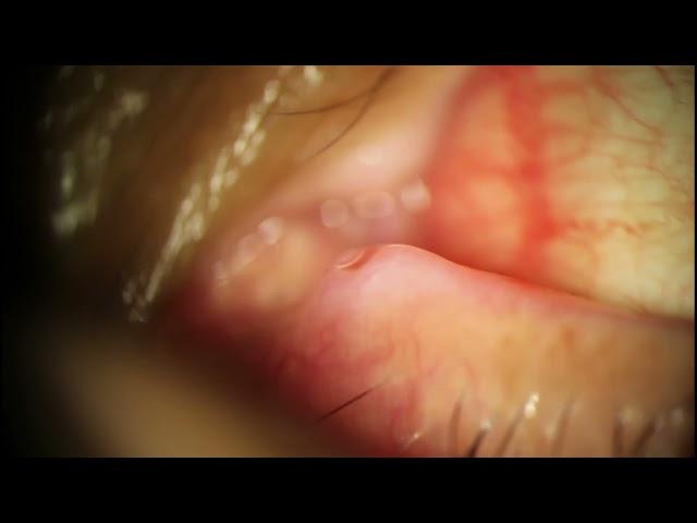 Dacryocystitis Expression - Infected Tear Duct Pus Explosion