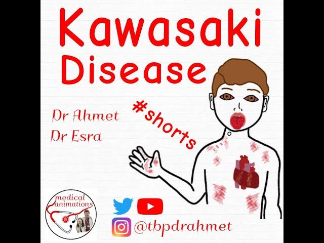 DIAGNOSTIC CRITERIA for KAWASAKI DISEASE | #shorts #pediatrics #cardiology