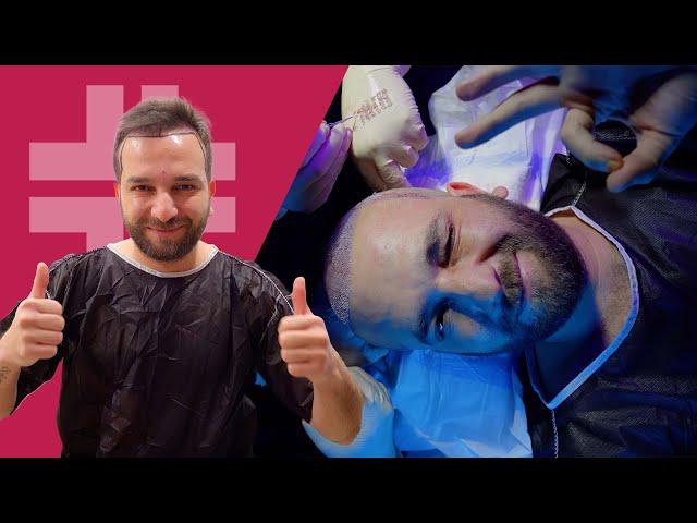 Maximum Density Hair Transplant