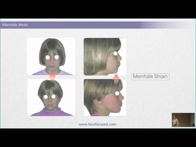 The Case Against Facial Muscle Strain - William M. Hang, DDS, MSD