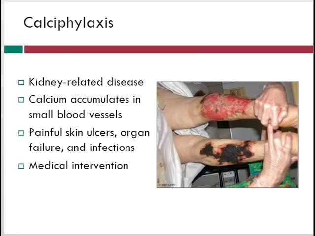 Calciphylaxis | Wound Care Topics | Free Wound Care Info | WoundEducators.com