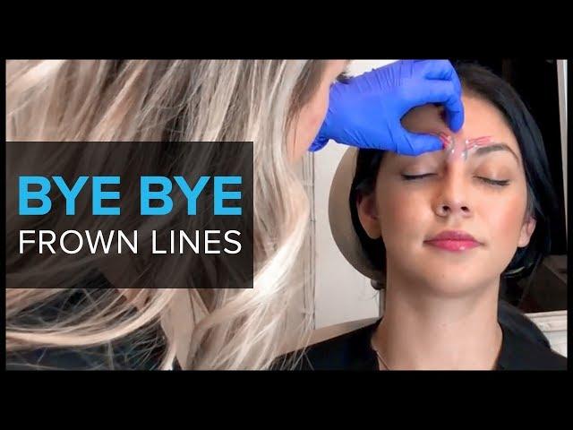 Why We Use BOTOX For Frown Lines